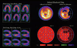 Angioplastyin Houston