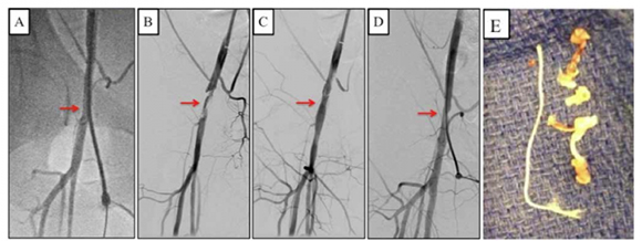 Peripheral Angiography, Angioplasty, Stenting, Atherectomy