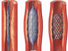 Coronary Angioplasty (PTCA) and Stenting